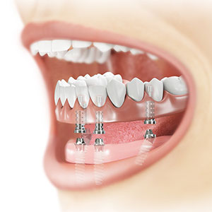 Multi-Unit Abutment